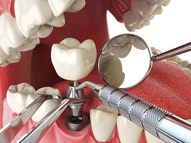 Best Urgent Tooth Repair  in Gothenburg, NE
